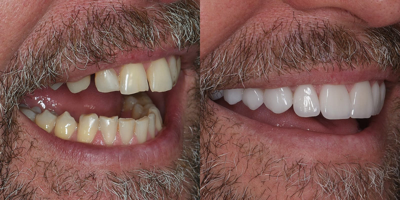 Before and after porcelain veneers in Pompano Beach, worn upper teeth restored to an even shape