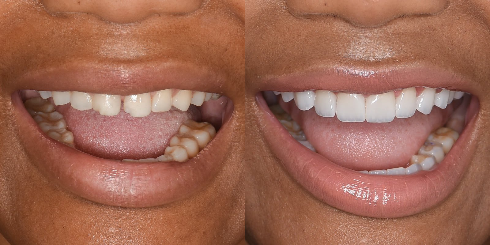 Porcelain veneers before and after, short front teeth given back length and proportion