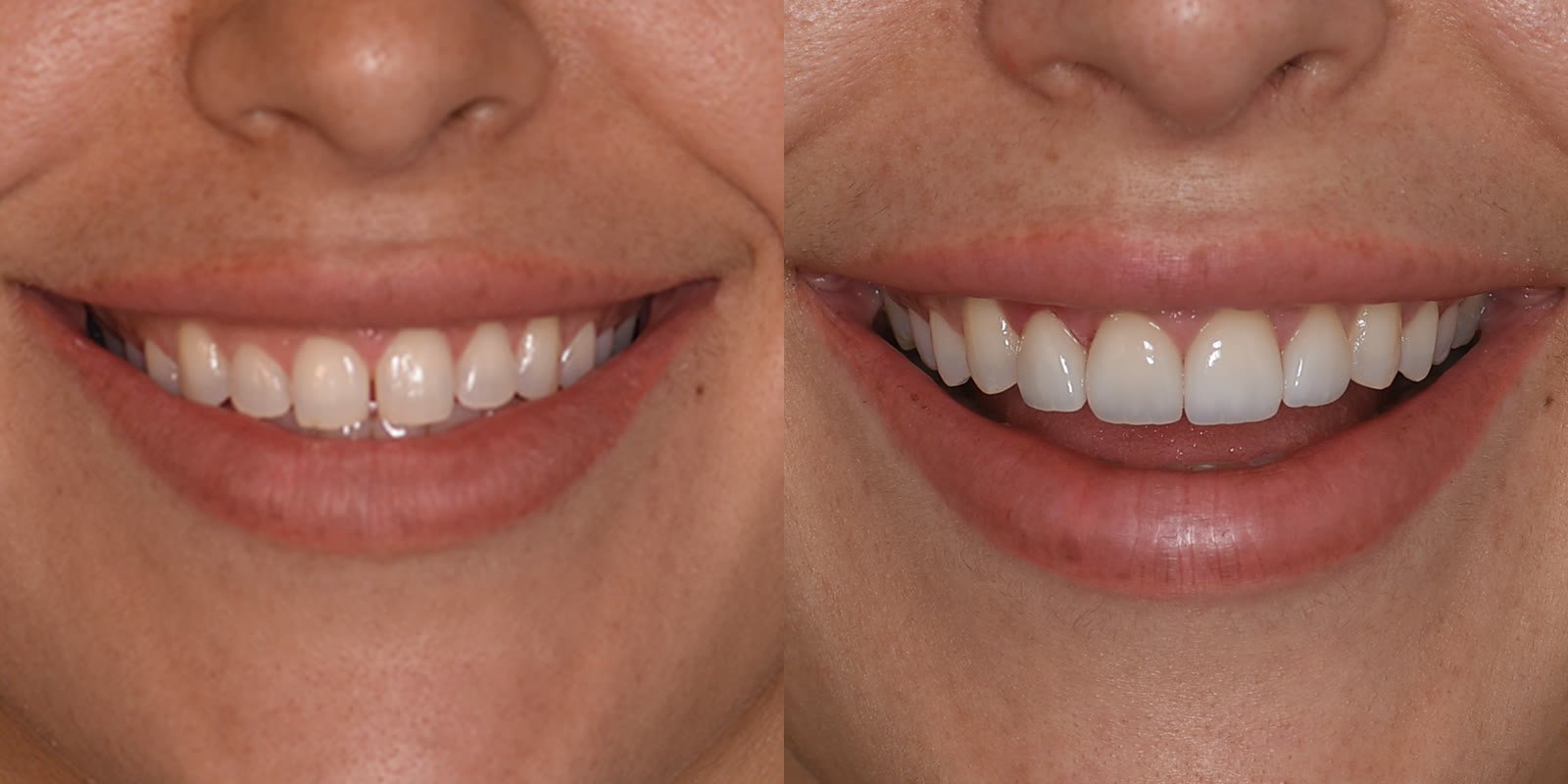 Digital smile design before and after, uneven upper smile evened out and brightened