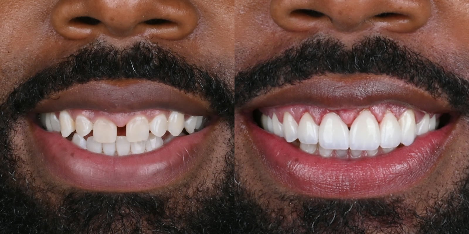 Porcelain veneers closing a gap between the front teeth, before and after