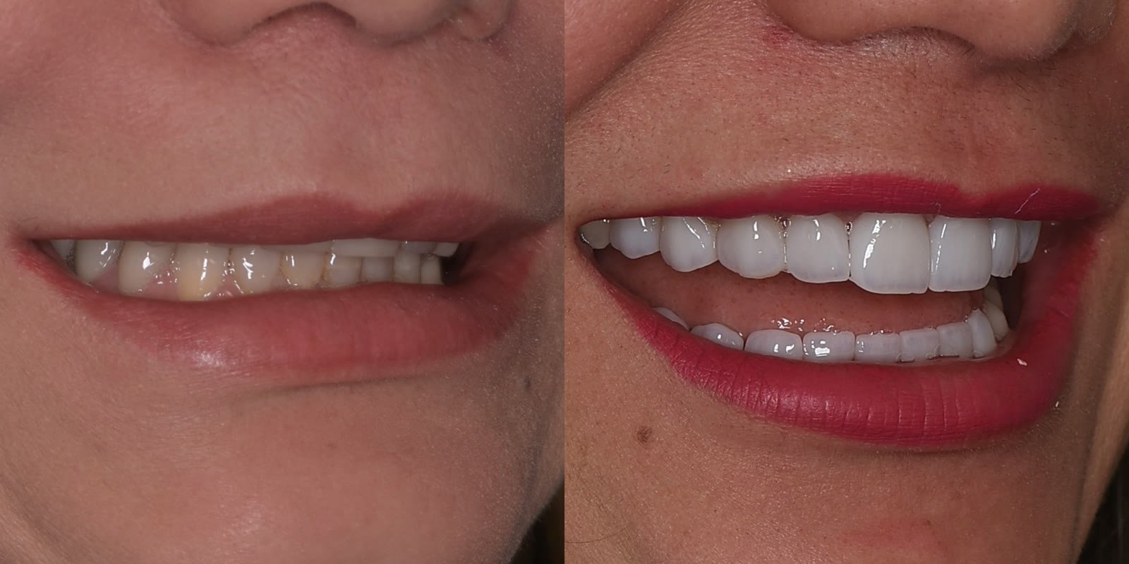 Full mouth rehabilitation before and after, worn bite rebuilt on both arches
