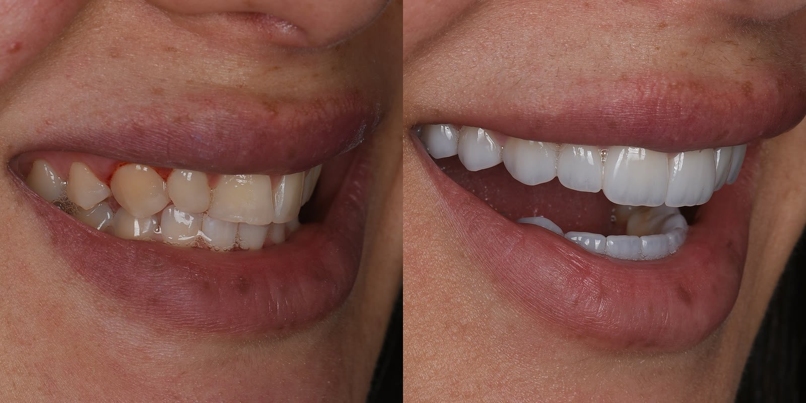 Smile design before and after, crowded upper teeth reshaped into an even line