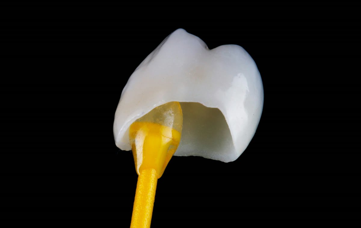 Porcelain crown matched to the neighbouring teeth at Lumina Dental Studio