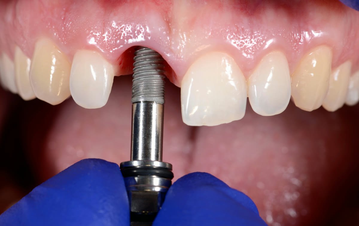 Dr. Reynaldo Novoa planning a dental implant in 3D at Lumina Dental Studio
