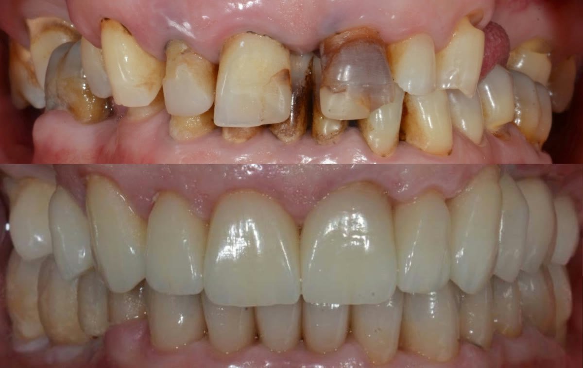 Full mouth rehabilitation case at Lumina Dental Studio in Pompano Beach