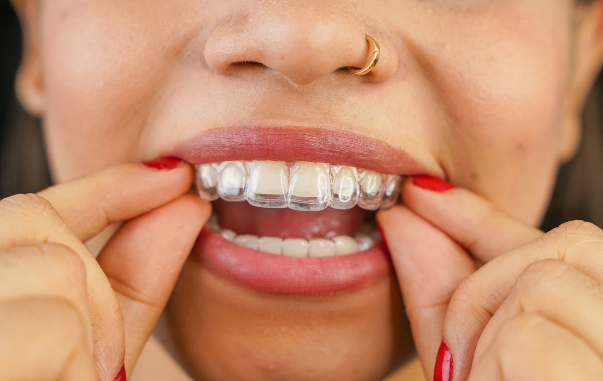 Patient holding an Invisalign clear aligner at Lumina Dental Studio in Pompano Beach