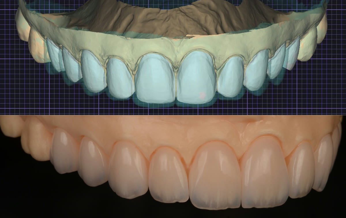 Digital smile design overlaid on a patient’s photograph at Lumina Dental Studio