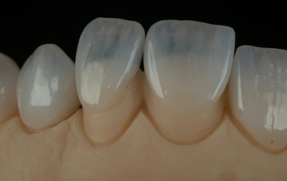 Close-up of a finished porcelain veneer case at Lumina Dental Studio in Pompano Beach